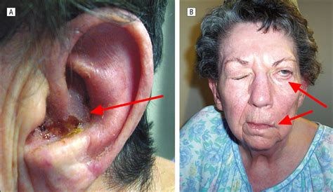 ramsay hunt syndrome